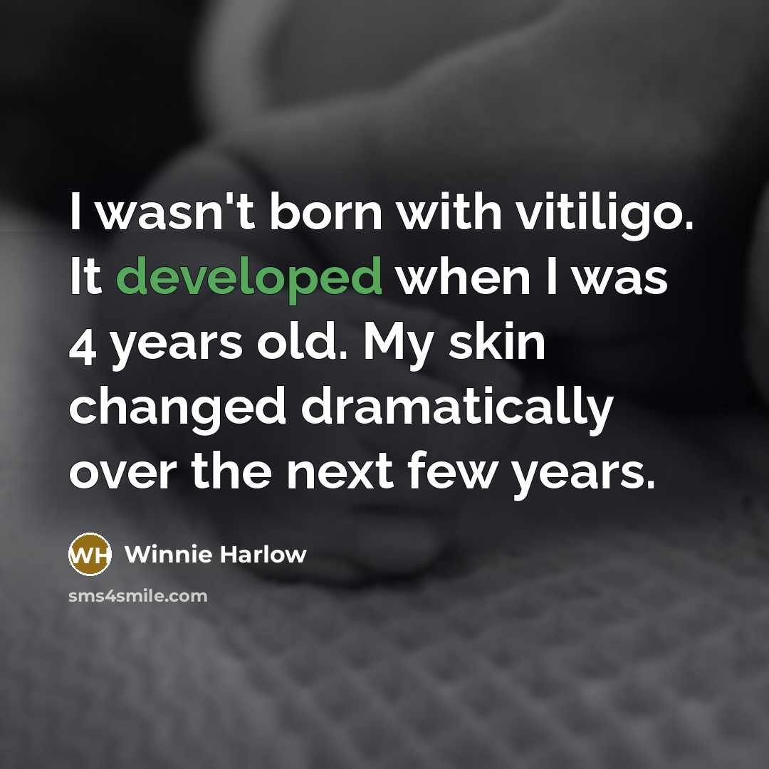“I wasn't born with vitiligo. It developed when I was 4 years old. My skin changed dramatically over the next few years.” quote by Winnie Harlow