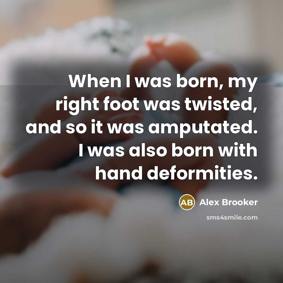 “When I was born, my right foot was twisted, and so it was amputated. I was also born with hand deformities.” quote by Alex Brooker