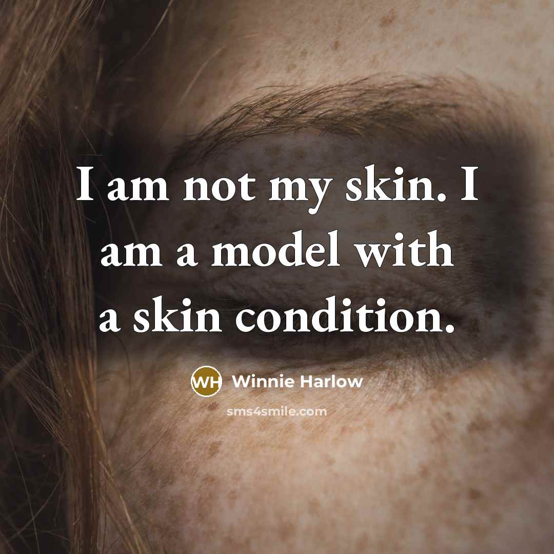 “I am not my skin. I am a model with…” quote by Winnie Harlow