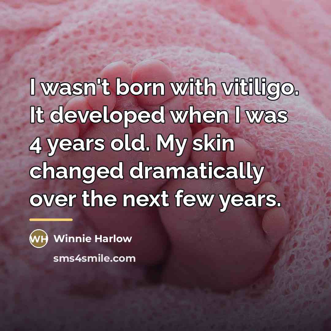 “I wasn't born with vitiligo. It developed when I was…” quote by Winnie Harlow