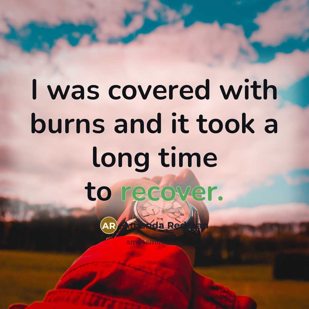 “I was covered with burns and it took a long time to recover.” quote by Amanda Redman